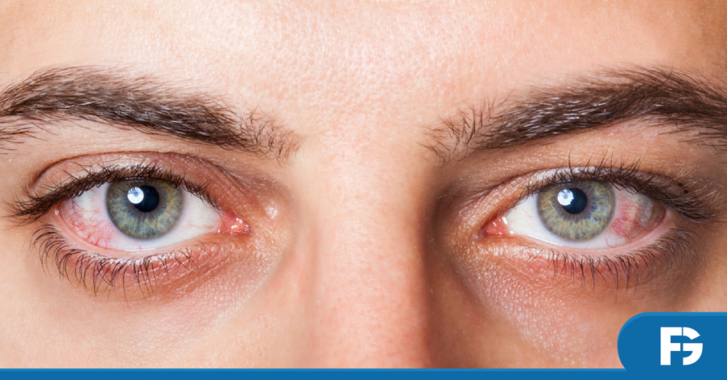 alergia-olho-oftalmologia